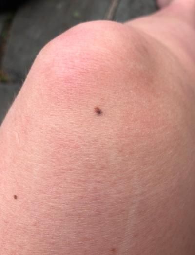 Stage 3 melanoma mole on a knee