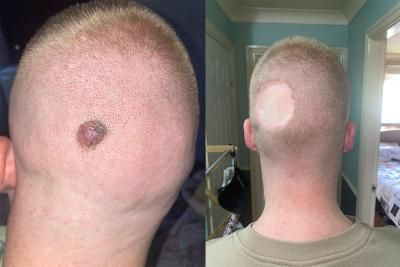 Melanoma mole on the back of head
