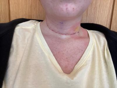 thyroid cancer scar