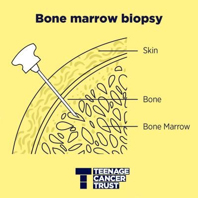 Line drawing shows a needle going through bone into bone marrow for a bone marrow biopsy