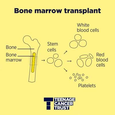 Line drawing show the location of bone and bone marrow and also showing how stem cells are made up of white and red blood cells and platelets